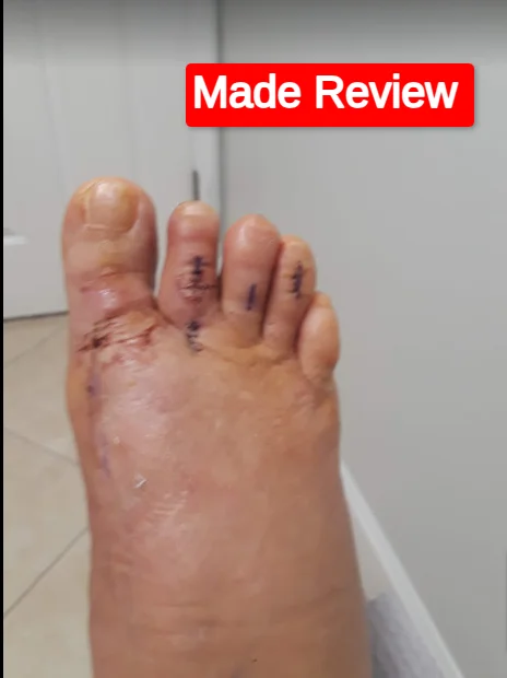 Lapiplasty Operation