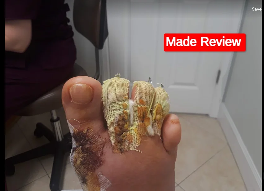 Lapiplasty Operation